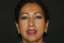 Ohren anlegen Bild nach OP 2